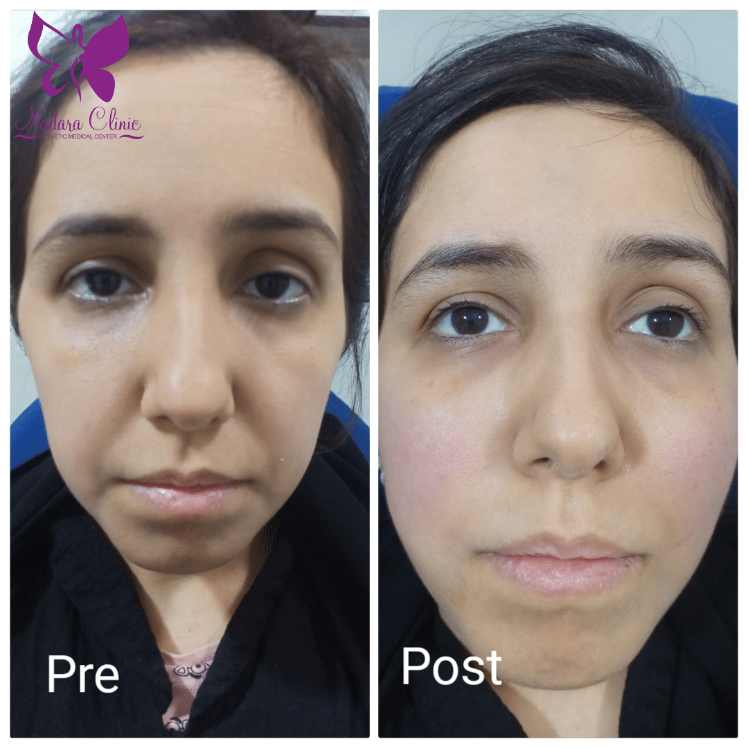 الخيوط الذهبية لشد الوجه